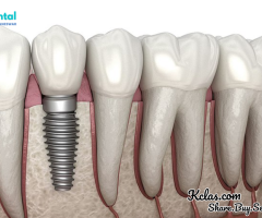 Discover the Best Dental Implants in Patia