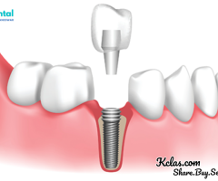 Discover the Best Dental Implants in Patia