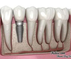 Top Dental Implant Clinics in Bhubaneswar – Schedule a Consultation - 1